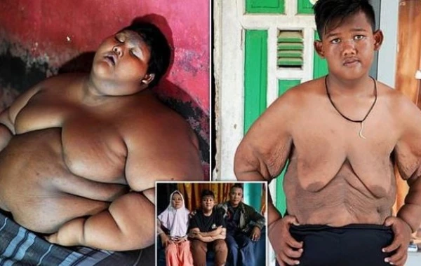 "Самый толстый ребенок в мире" похудел на 106 кг и нуждается в операции по удалению лишней кожи - ФОТО