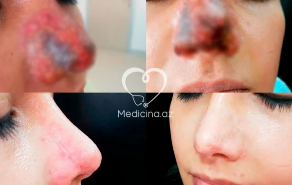Azərbaycanda 29 yaşlı qızın burnu çürüdü - kosmetoloqdan böyük səhv – FOTO