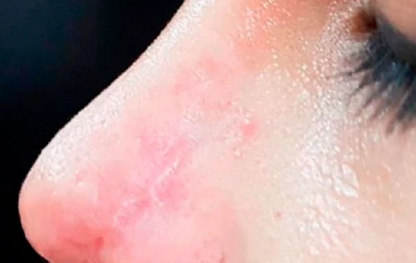 Azərbaycanda 29 yaşlı qızın burnu çürüdü - kosmetoloqdan böyük səhv – FOTO