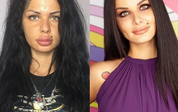 Ən böyük dodaqlı qız bu hala düşdü - FOTO