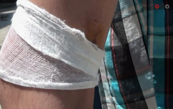 В Азербайджане бездомная собака укусила 11-летнего ребенка - ФОТО