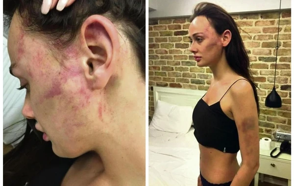 Модель обнажила следы жестокого избиения - ФОТО