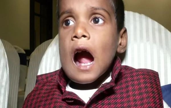 Hindistanda azyaşlının ağzından 526 diş çıxarılıb - VİDEO