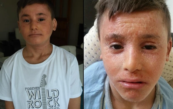 Azərbaycanlılar nadir xəstəliyə tutulan türk uşağın anasını sevindirdilər - VİDEO