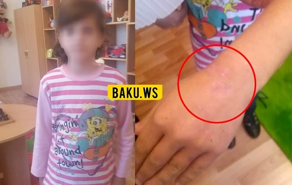 Azərbaycanda ana övladının əlinə siqaret kötüyü basdı, uşaq evdən qaçdı - FOTO