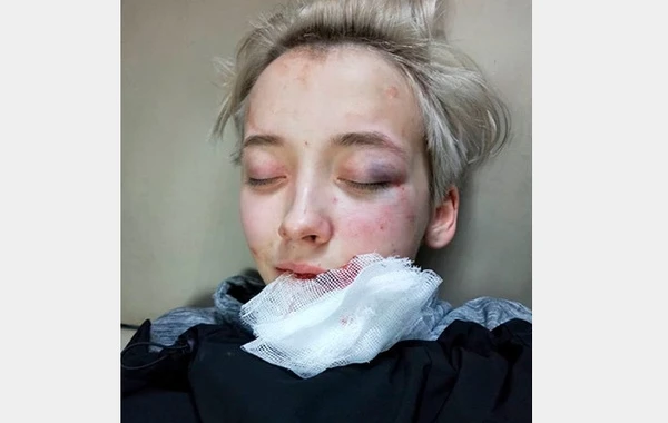 В России 7 мужчин жестоко избили 18-летнюю девушку из-за внешнего вида - ФОТО