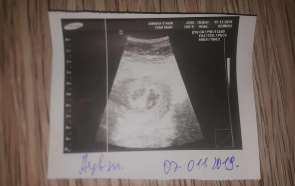 Bakıda yeni doğulan əkizlərdən biri xəstəxanada satılıb? – RƏSMİ AÇIQLAMA