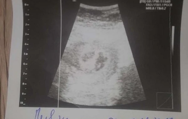 Bakıda yeni doğulan əkizlərdən biri xəstəxanada satılıb? – RƏSMİ AÇIQLAMA