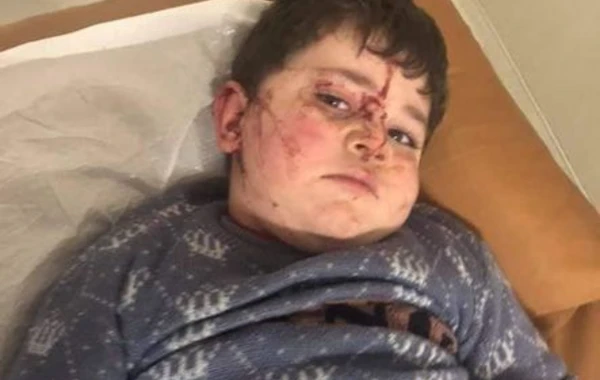 Среди пострадавших в результате вражеского обстрела Гянджи есть малолетние дети – ВИДЕО