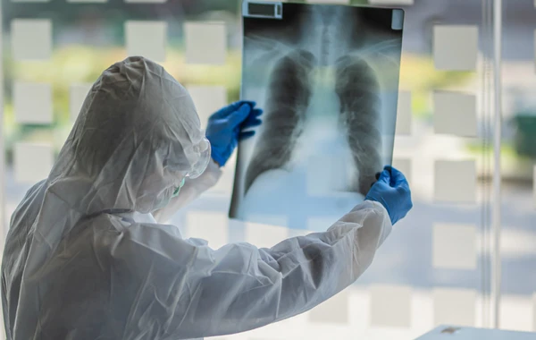 Pulmonoloqdan XƏBƏRDARLIQ: “Koronavirus xəstələrinə standart müalicə tətbiq etmək olmaz”