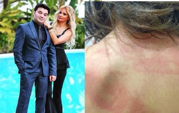 Əməkdar artistin gəlini qızının işgəncəyə məruz qaldığını iddia edir - FOTO