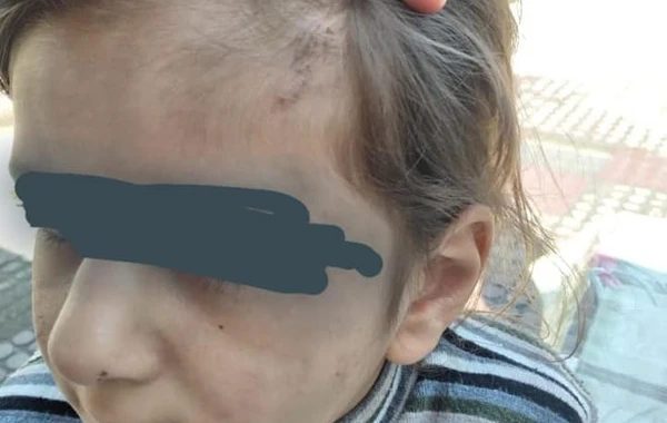 7 yaşlı qızın döyülməsi araşdırılır - RƏSMİ AÇIQLAMA - FOTO