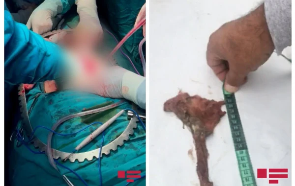Azərbaycanda ŞOK OLAY - Qarnında unudulan tampon 8 ay sonra çıxarıldı - VİDEO