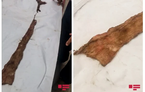 Azərbaycanda ŞOK OLAY - Qarnında unudulan tampon 8 ay sonra çıxarıldı - VİDEO
