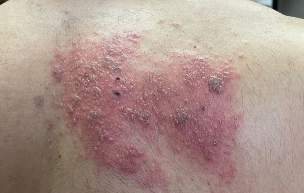 Bakıda "Pfizer" peyvəndi vurulan gəncin bədənində səpkilər yarandı - SƏBƏB/FOTO