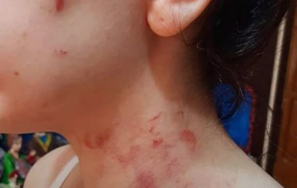 Sığınacaqdan anasının yanına dönən 15 yaşlı qız növbəti dəfə bədənində xəsarətlərlə evdən qaçdı - FOTO