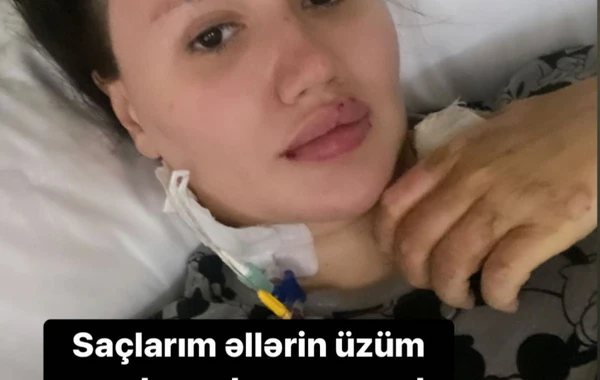 Gecə klubundakı partlayışda yanan Aysel: "Böyrəklərim və ağciyərim də zədələnib" - FOTO