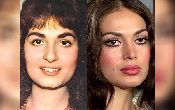 Türkan Şorayı dəyişdirən PLASTİK ƏMƏLİYYATLAR VƏ QİYMƏTLƏRİ - FOTO