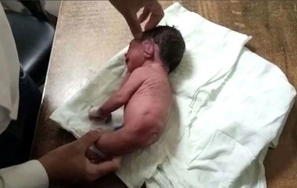 Yeni doğulan körpə həkimləri şoka saldı - FOTOlar