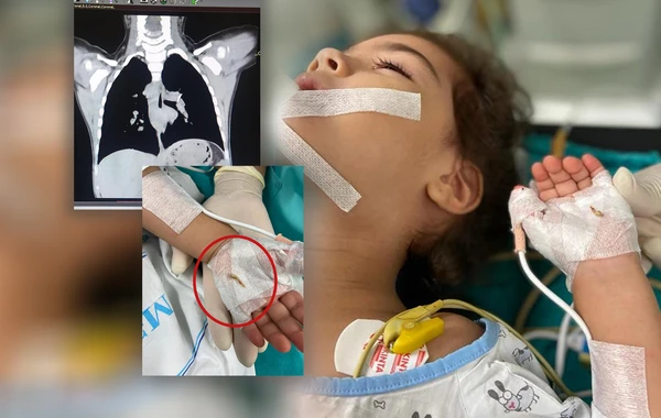 Bakıda 2 yaşlı uşaq bir il nəfəs borusunda sümük parçası ilə yaşayıb - FOTO