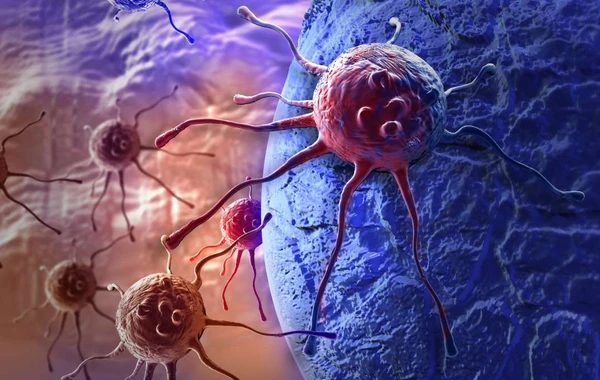 Süni intellekt süd vəzi xərçəngini 5 il əvvəlcədən proqnozlaşdıra bilər