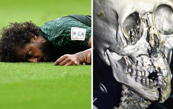 DÇ-da zədələnən oyunçunun burnu, üç dişi və üz sümükləri sındı - FOTO