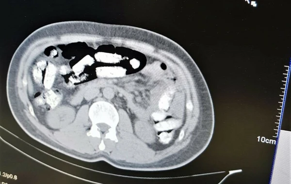 Mədəsində narkotik keçirməyə çalışan şəxs Erzincanda saxlanıldı - FOTO