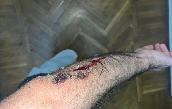Bakıda jurnalisti və müğənnini avtomobil vurdu - FOTO