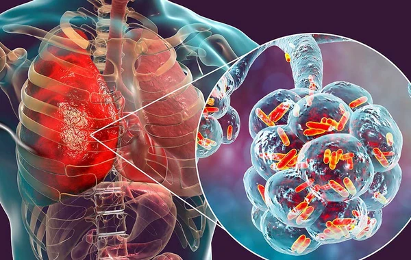 Hovuz və kondisionerlər vasitəsi ilə dəhşətli virus yayılır
