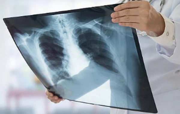 Bunu etsəniz ağ ciyər xərçənginə yoluxma riskiniz 90% azalar