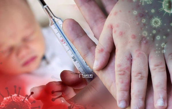 Nə üçün qızılcadan ölənlərin sayı artır?  - AÇIQLAMA - VİDEO