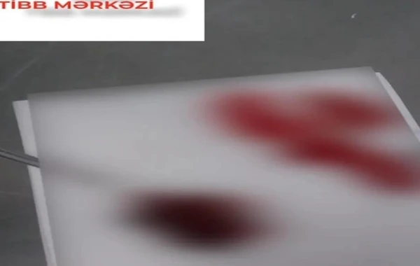 Bakıda 19 yaşlı qızın burnundan 10 il əvvəl özünün saldığı muncuq çıxarılıb - FOTO