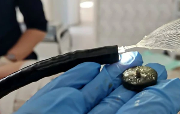Həkimlər beş yaşlı qızın mədəsindən maqnit çıxartdılar