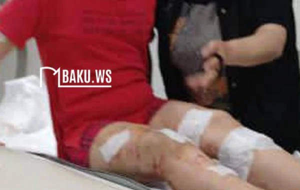 Стало известно о состоянии 11-летней девочки, покусанной бездомными собаками - ФОТО