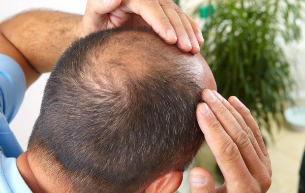 Выпадение волос как характерная черта кавказских народов: врач назвал причину