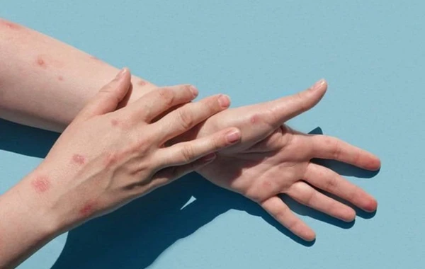 Həyəcan təbili: Azərbaycanda meymunçiçəyi aşkarlandı? - VİDEO