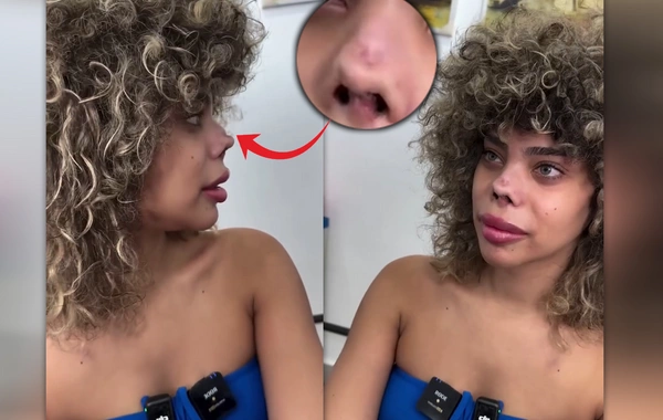 Türkiyədə plastik əməliyyat olunan qadın burnunun yarısını itirdi