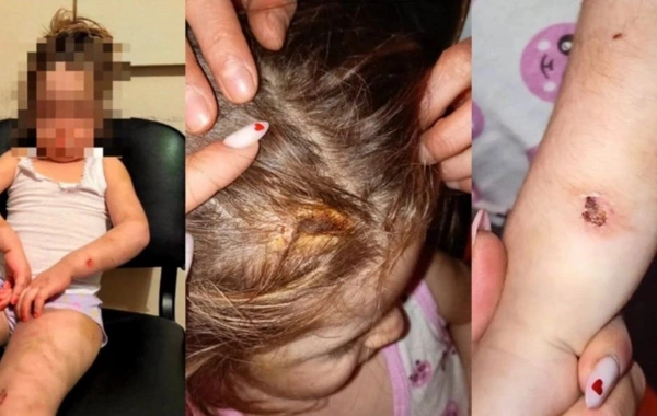 Bakıda ana azyaşlı qızının bədəni yandırdı, kəmərlə döydü - TƏFƏRRÜAT