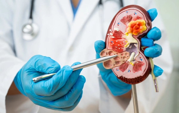 Products that protect against kidney stone formation have been named