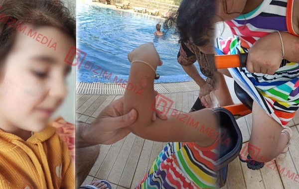 Lənkəranda qandonduran HADİSƏ – Ana isti qaşıqla 3 yaşlı qızının qolunu DAĞLADI