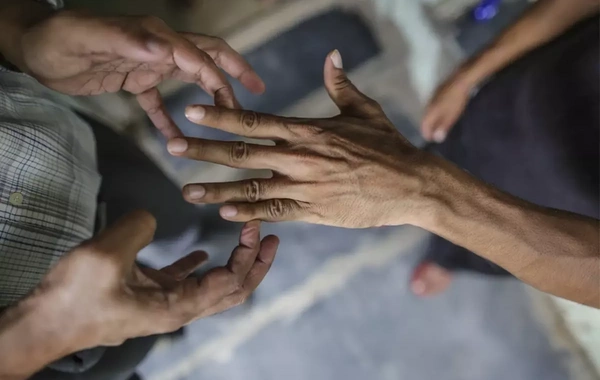 Rumıniyada 44 il sonra ilk dəfə cüzam xəstəsi aşkarlandı