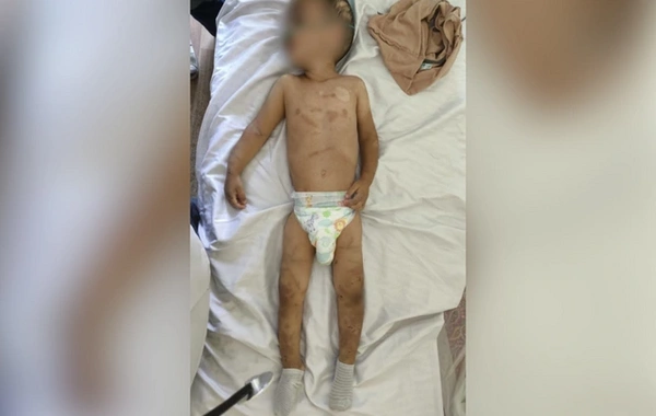 Ağdamda işgəncəyə məruz qalan körpələrin son durumu: Biri Neyrocərrahiyyə Xəstəxanasına aparılıb