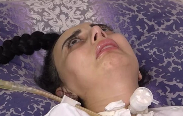 Bakıda rinoplastika əməliyyatından sonra iflic olan 34 yaşlı qadın öldü