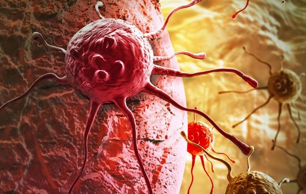 Nazir: Onkoloji xəstəliklər regionda ölüm hallarının əsas səbəblərindən biridir