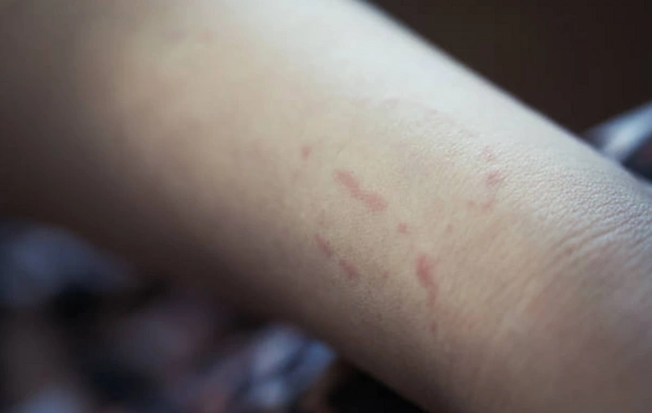 Salyanda kişi qısqanc sevgilisini döyüb dişlədi