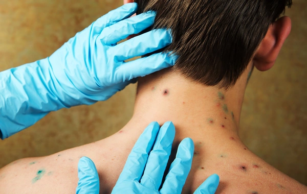 Врач рассказала, можно ли заболеть ветрянкой во второй раз