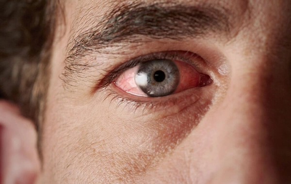 Yaşlı insanlarda gözlərin sulanmasının üç əsas SƏBƏBİ