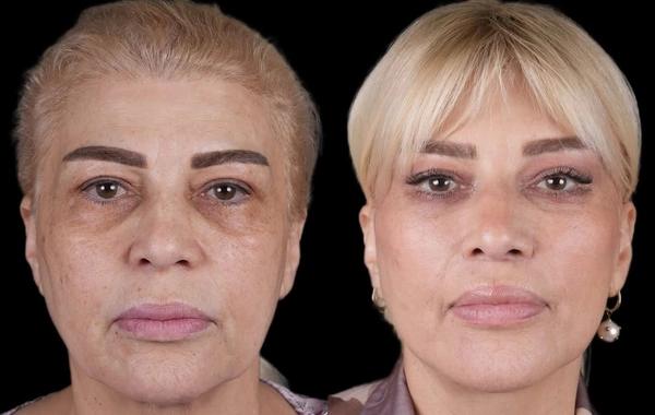 Mətanət İsgəndərli əməliyyatdan ƏVVƏL VƏ SONRA