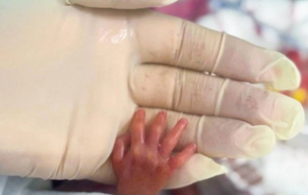 540 qram çəki ilə dünyaya gələn uşağın həyatı xilas edildi