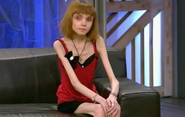 17 Kiloqram çəkisi olan fenomen qadın: Hər kiloqram qələbədir